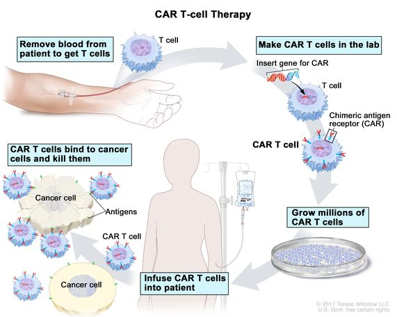CAR-T 세포 치료