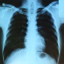 X-ray 영상